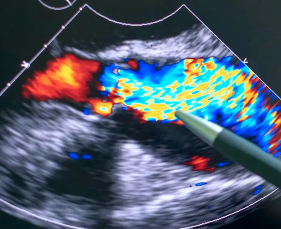 Imagem de ultrassom com Doppler colorido mostrando o fluxo de sangue em um vaso